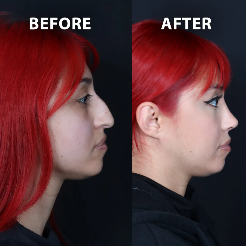 right side view rhinoplasty before and after photos by noses and necks nyc AA