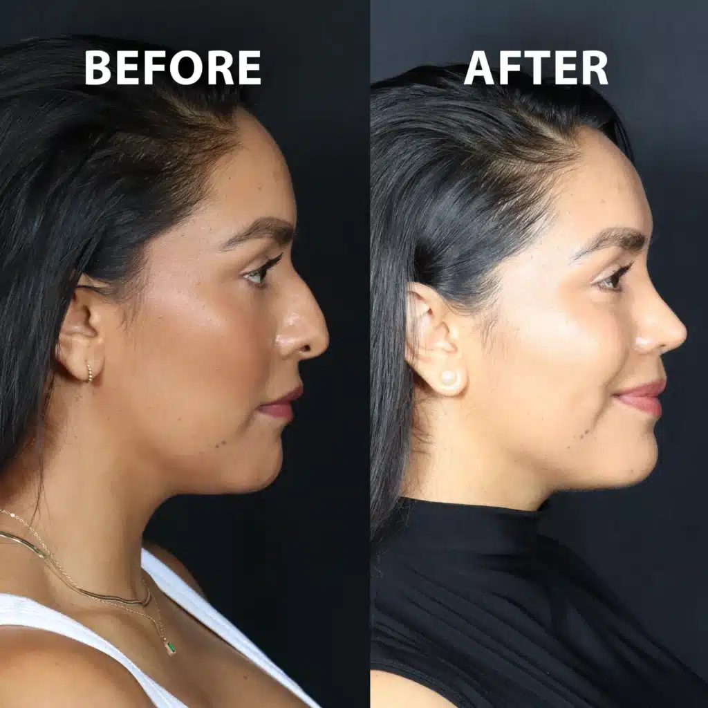 right side view rhinoplasty before and after photos by noses and necks nyc JS