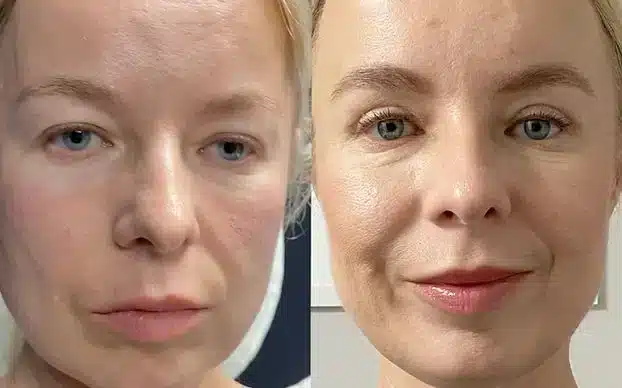 blepharoplasty before after blepharoplasty before after
