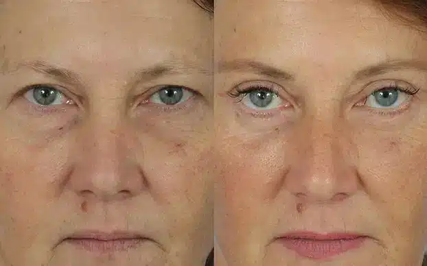 blepharoplasty before after blepharoplasty before after