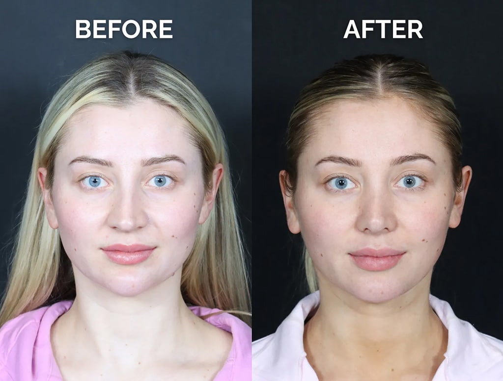 Front view revision rhinoplasty before and after photos by noses and necks nyc