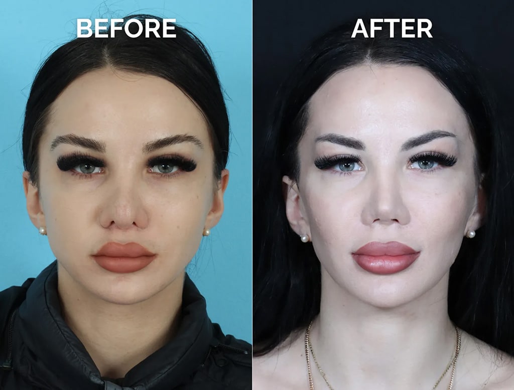 front view eastern european revision rhinoplasty before and after photos by noses and necks nyc