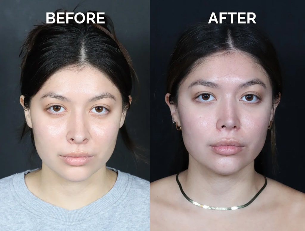 front view hispanic revision rhinoplasty before and after photos by noses and necks nyc