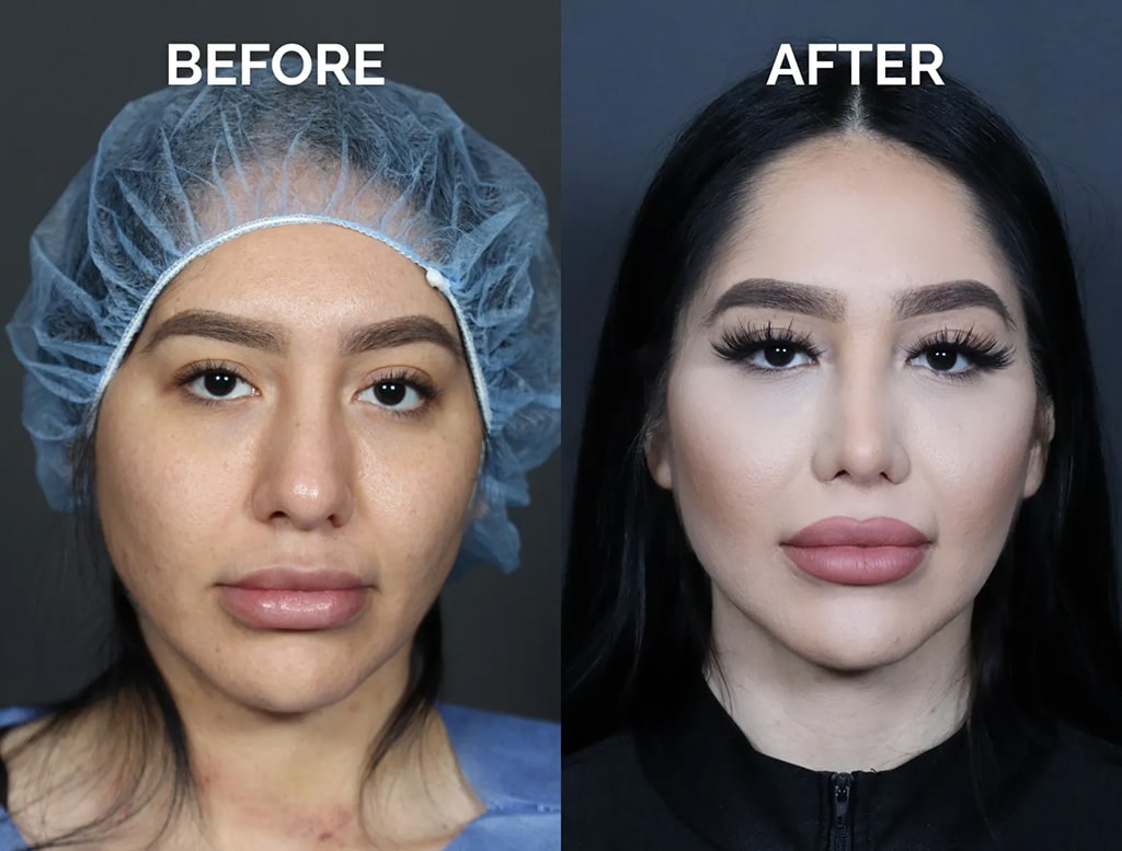 front view hispanic revision rhinoplasty before and after photos by noses and necks nyc