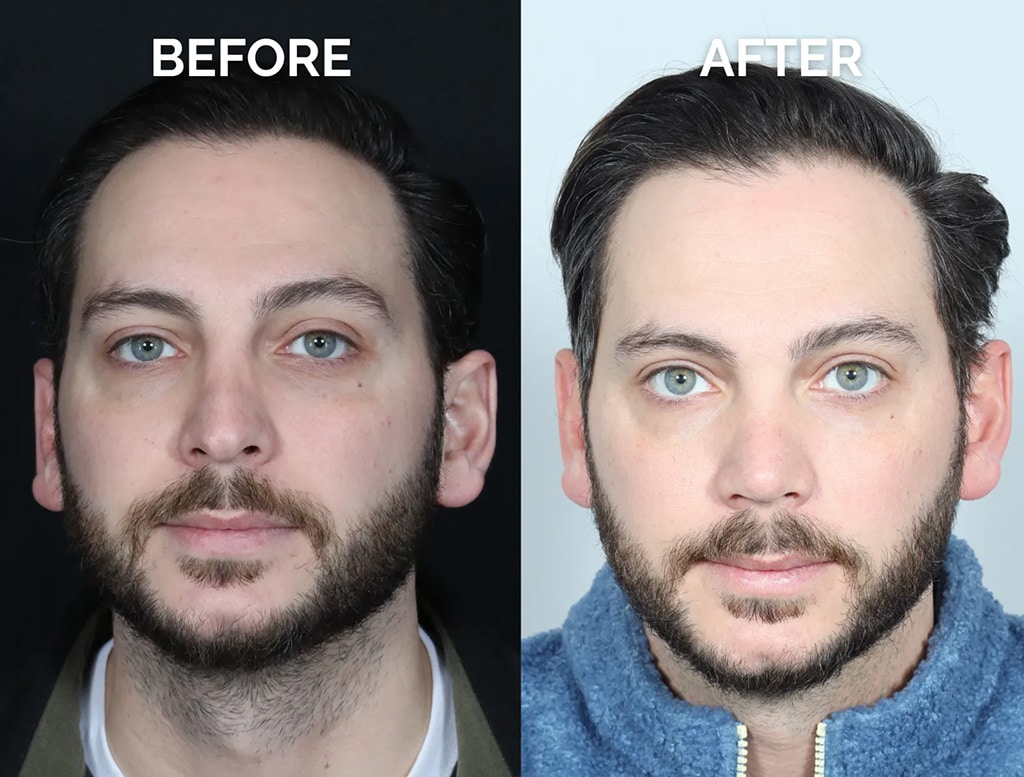 front view male revision rhinoplasty before and after photos by noses and necks nyc