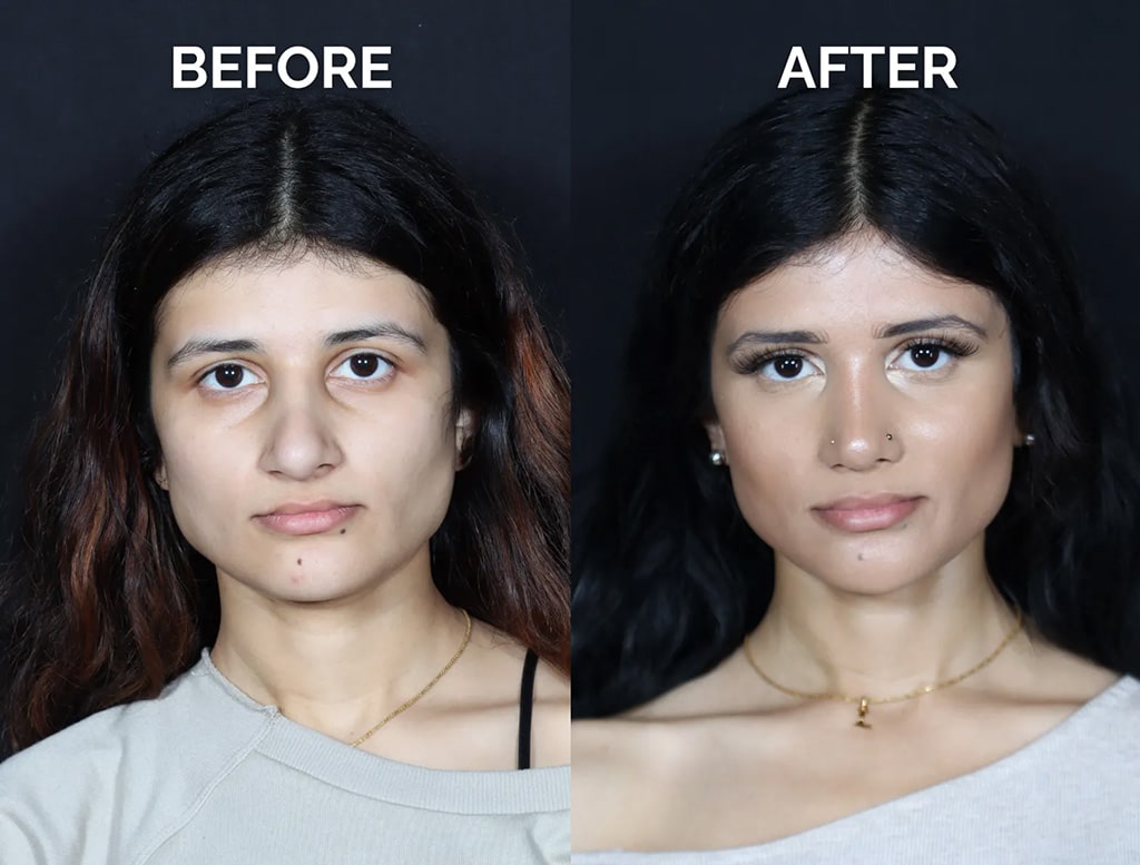 front view middle eastern revision rhinoplasty before and after photos by noses and necks nyc