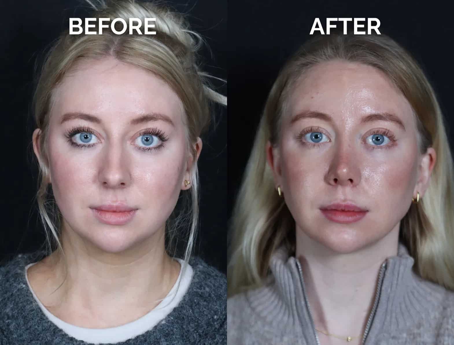 front view revision rhinoplasty before and after photos by noses and necks nyc