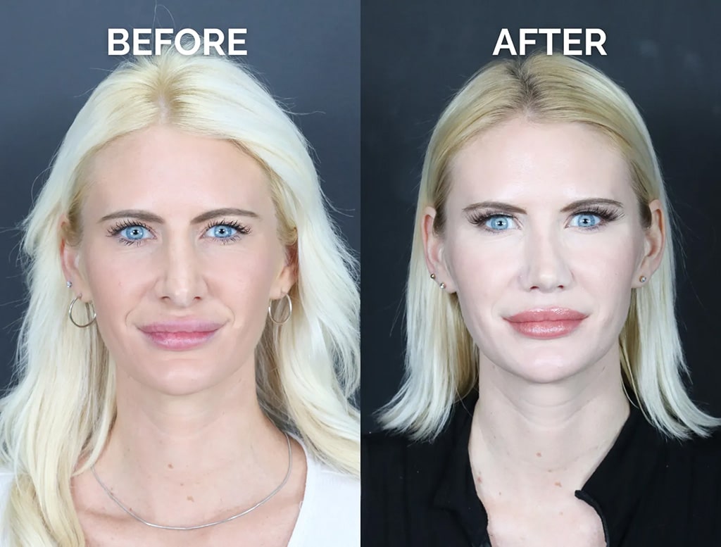front view revision rhinoplasty before and after photos by noses and necks nyc