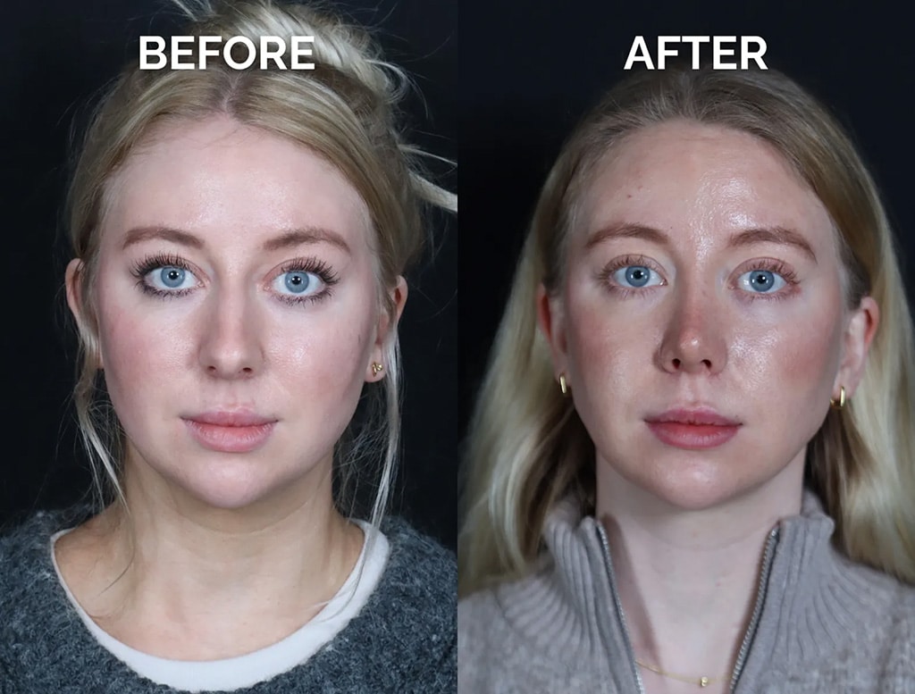 front view revision rhinoplasty before and after photos by noses and necks nyc