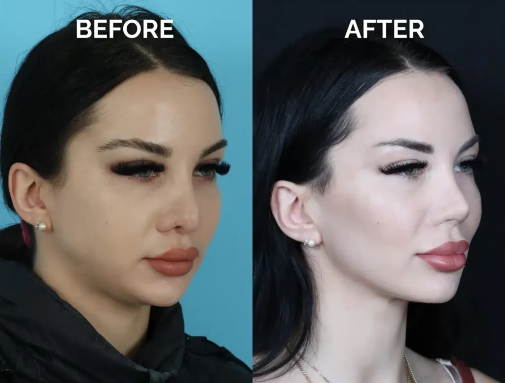right oblique view eastern european revision rhinoplasty before and after photos by noses and necks nyc