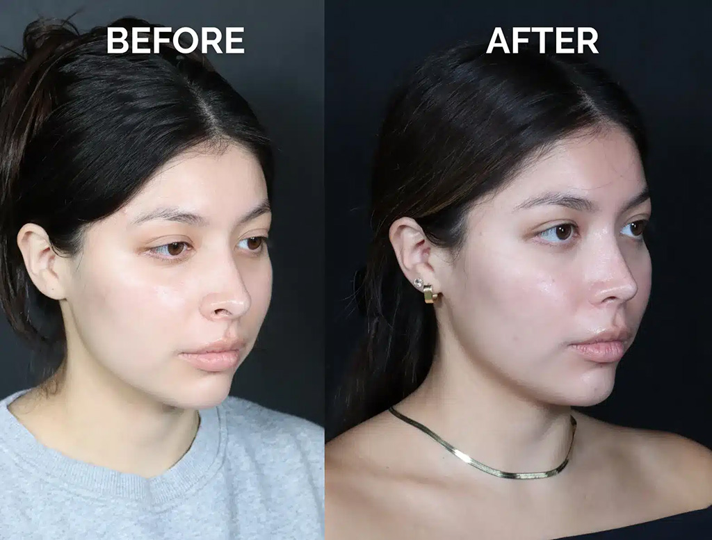 right oblique view hispanic revision rhinoplasty before and after photos by noses and necks nyc