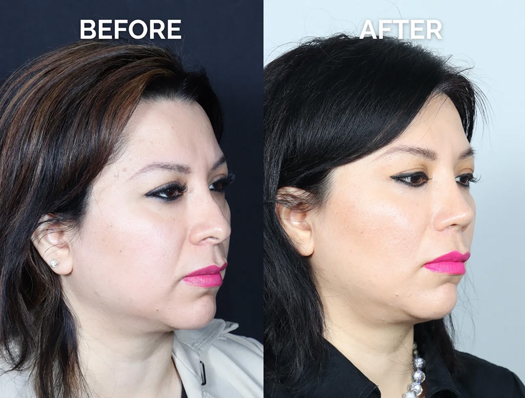 right oblique view hispanic revision rhinoplasty before and after photos by noses and necks nyc
