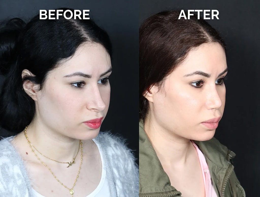 right oblique view hispanic revision rhinoplasty before and after photos by noses and necks nyc