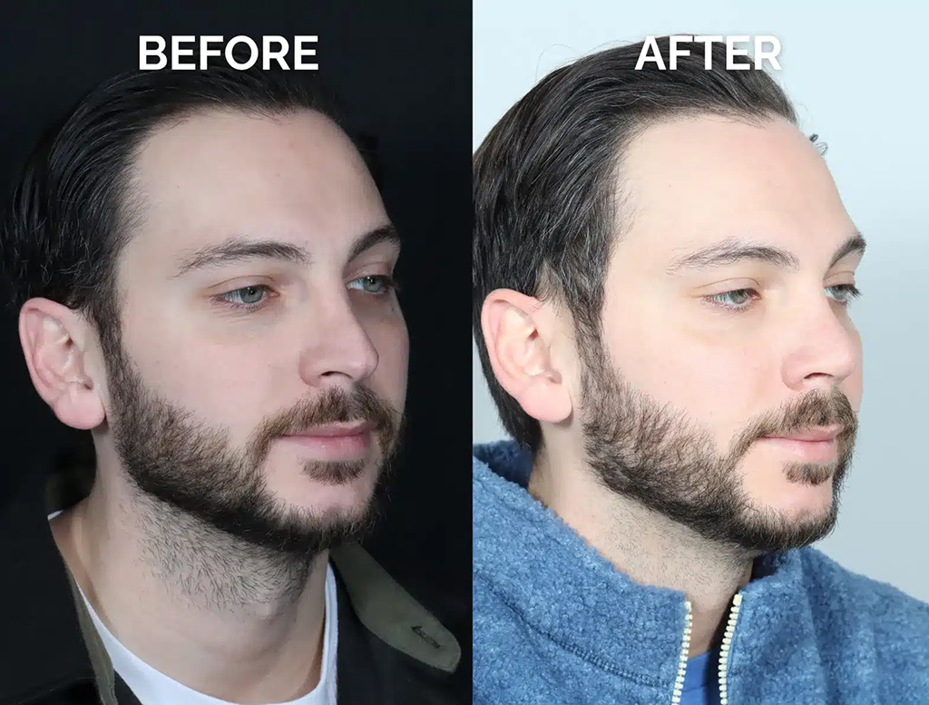 right oblique view male revision rhinoplasty before and after photos by noses and necks nyc