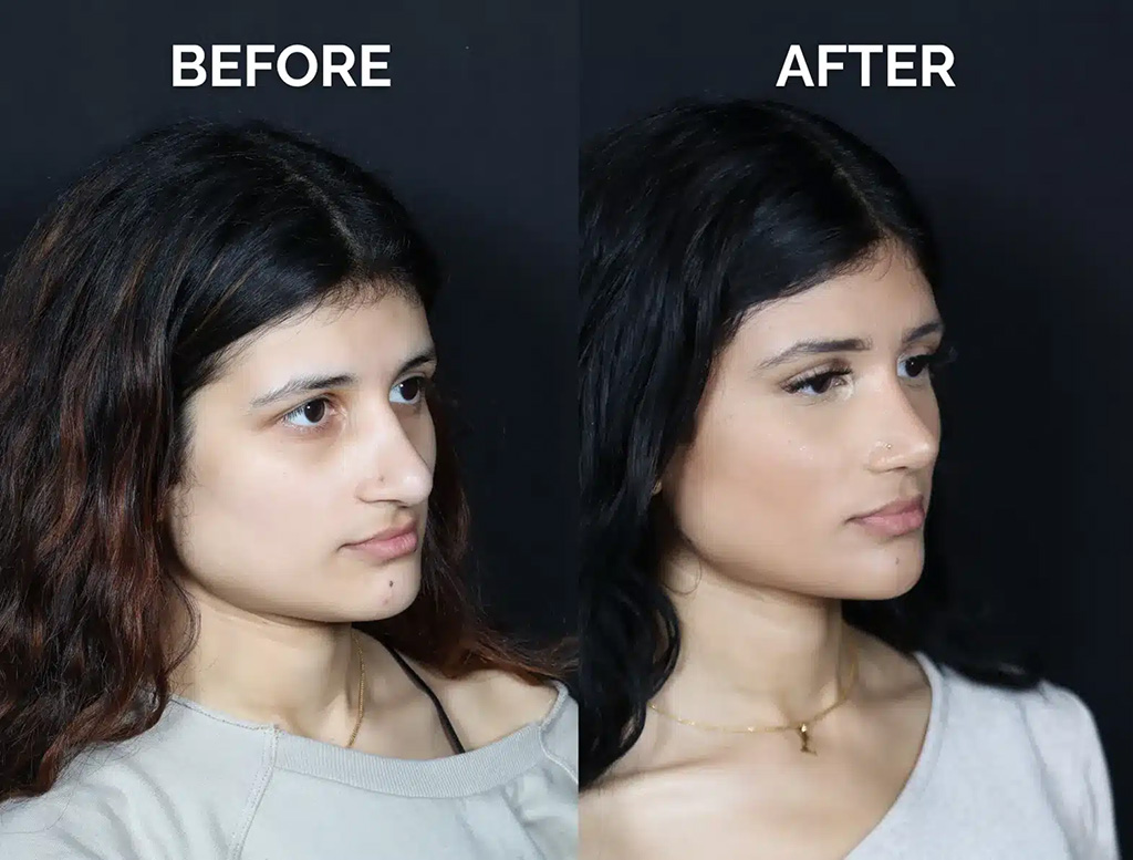 right oblique view middle eastern revision rhinoplasty before and after photos by noses and necks nyc