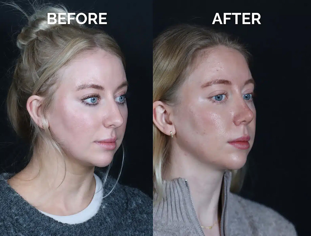right oblique view revision rhinoplasty before and after photos by noses and necks nyc