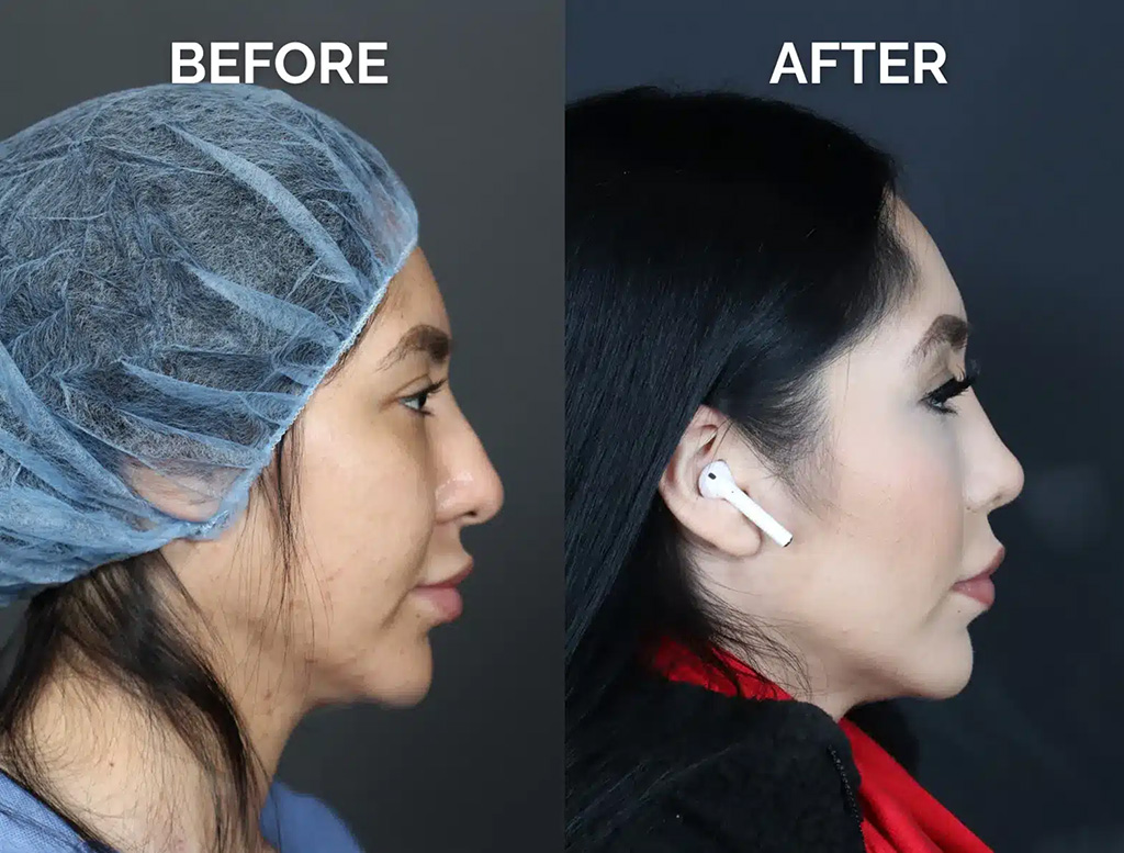 right side view hispanic revision rhinoplasty before and after photos by noses and necks nyc