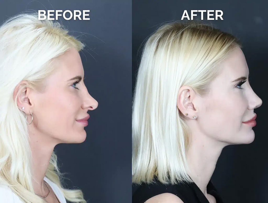 right side view revision rhinoplasty before and after photos by noses and necks nyc pt