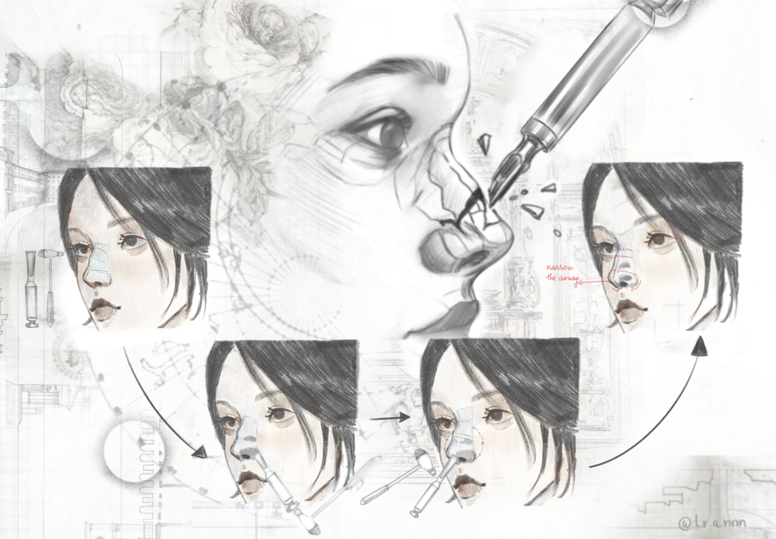 normal rhinoplasty technique