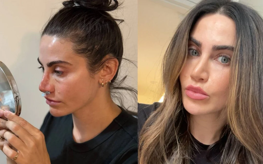 I Got a Rhinoplasty as a Beauty Editor—Here’s My Honest Review, One Year Later