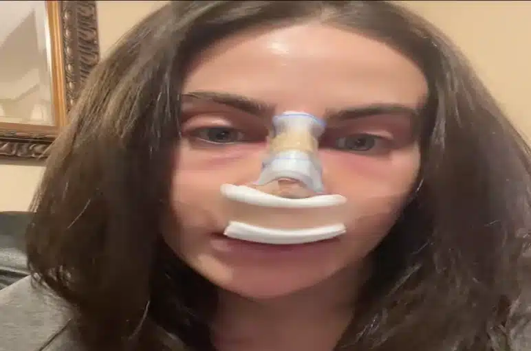 TikTok Influencer Patient Day 1 Post-Op Results