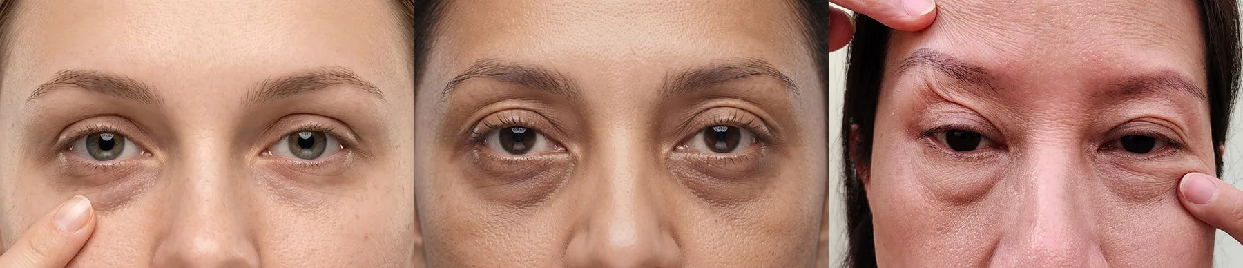Under Eye Bags vs Hollows vs Loose Skin